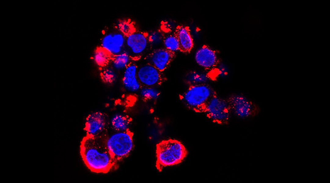 纳米颗粒为难以触及的脑肿瘤提供基因治疗