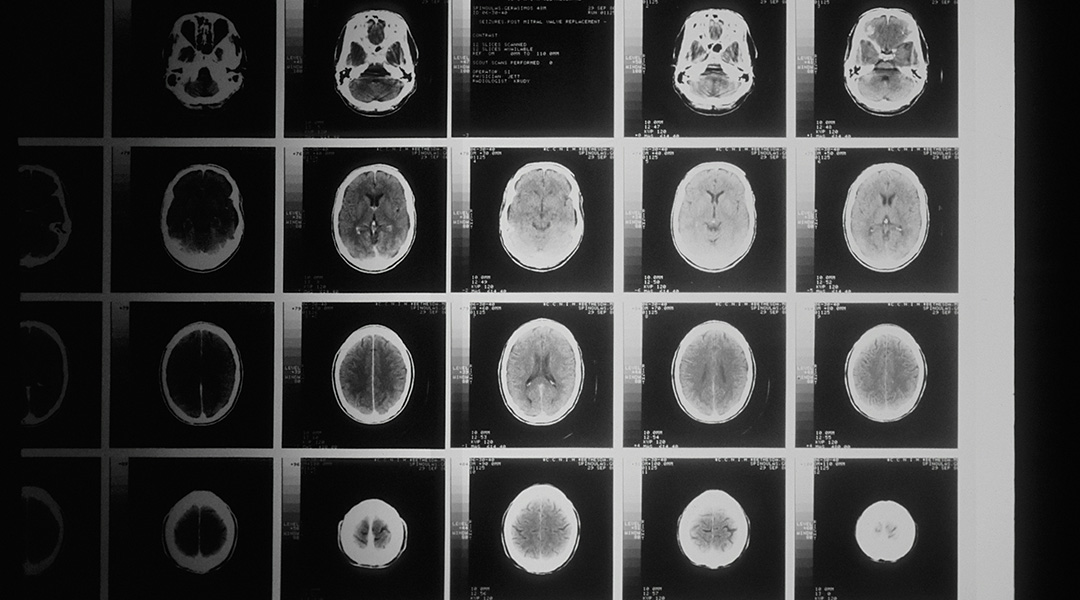 Brain X-rays on a black background.