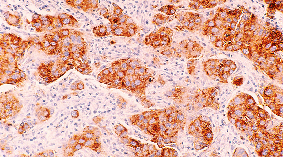 Image of breast cancer cells.