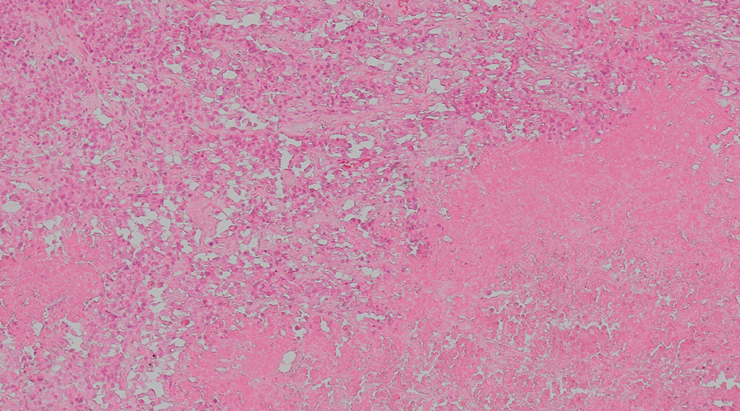 STain image for cancer therapy.