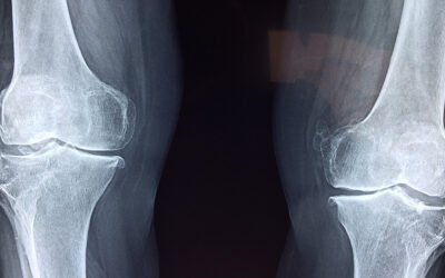 Chirality could be the key to successful bone repair