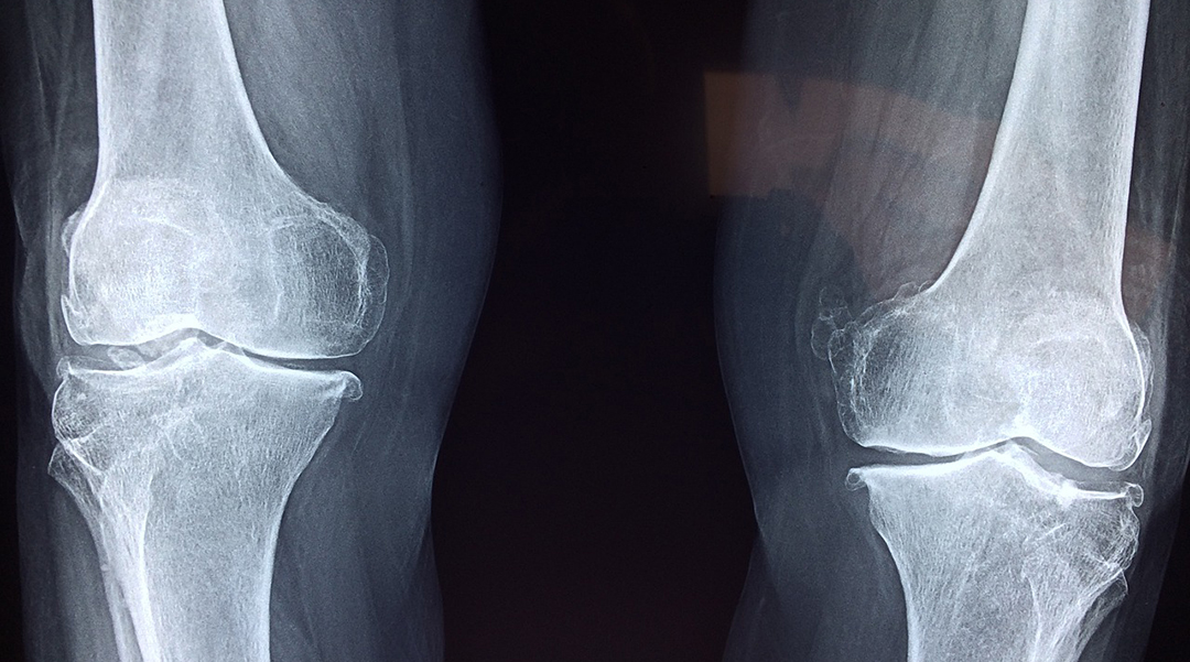 X-ray of a knee bone.